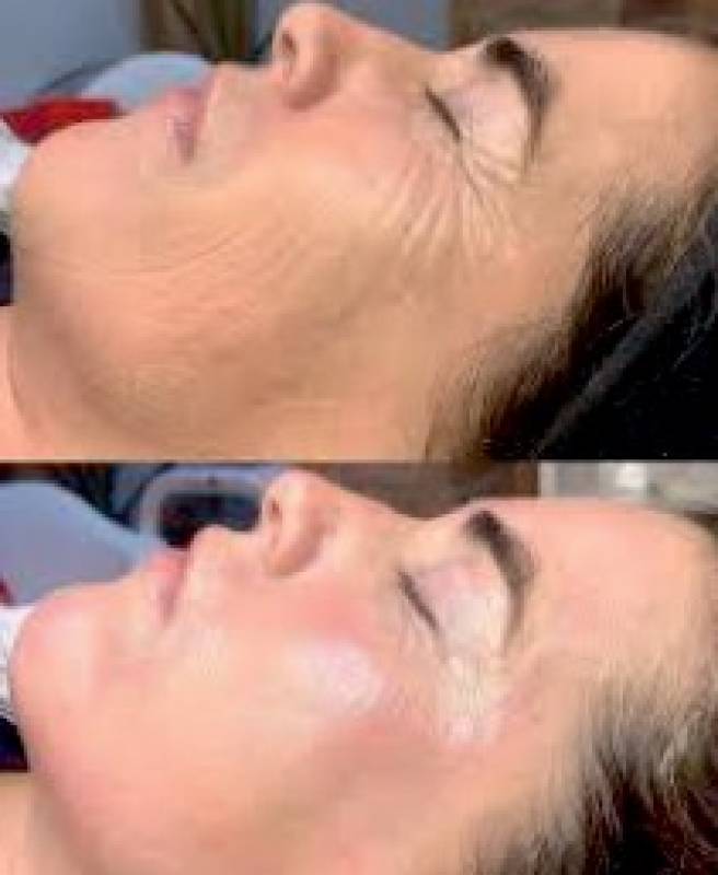 Reveal your best skin with the Hydra Pen Facial at The Salon Camposol